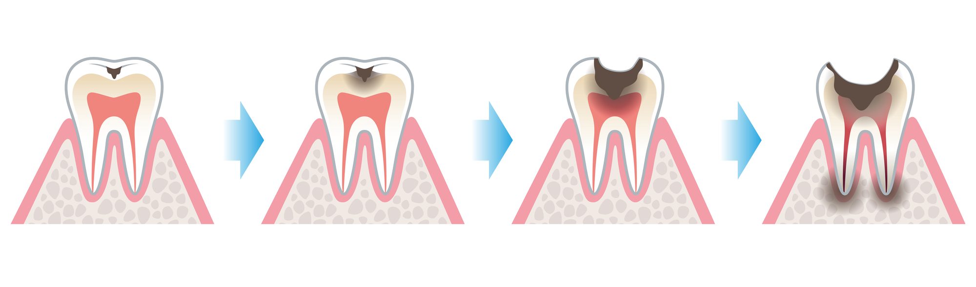 むし歯の進行｜石川町のマリーンデンタルクリニック