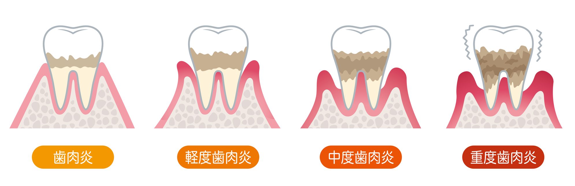 歯周病の進行｜石川町のマリーンデンタルクリニック